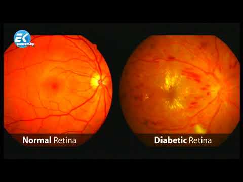 Видео: Отлепването на ретината причинява ли главоболие?
