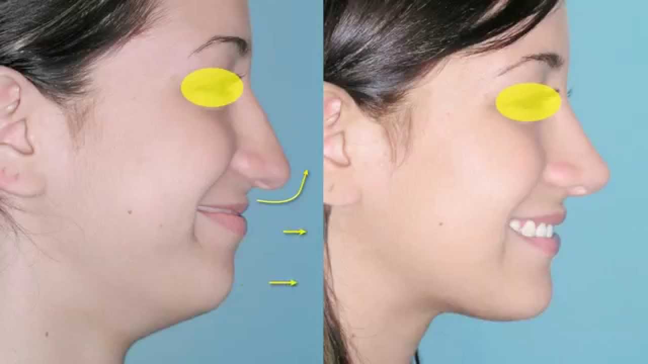 Rinoplastia, Mentoplastia y Cirugía de Papada para mejorar el perfil
