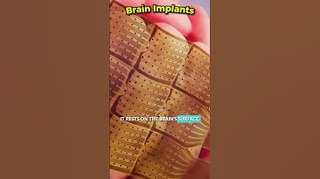 Brain Implants Are Changing Lives—Here’s Why You Should Care