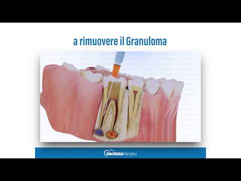 Video: Cos'è la chirurgia dentale apico?