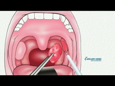 როგორ მივხვდეთ, გვაქვს თუ არა ტონზილების, იგივე გლანდების პრობლემა