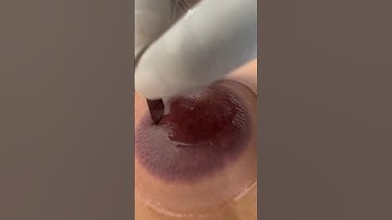 How to cut in Hijama by blade... #cupping #new #hijama #shorts #viral #trnding  #cupping_therapy