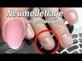 Kaputte Nägel Durch Kunstnägel