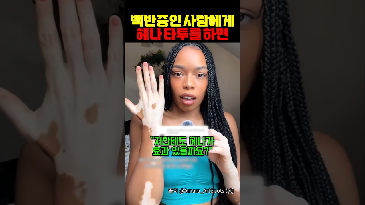 백반증이 헤나 타투를 하면