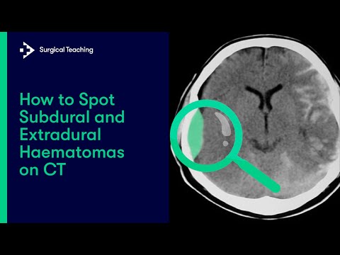 Video: Unterschied Zwischen Epidural Und Subdural