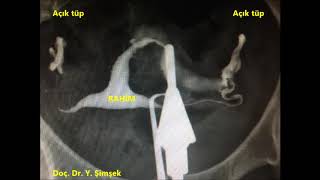 Dr. Yavuz Şimşek - Ultrasonografik rahim filmini (Hyfosy)