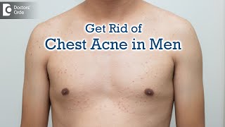 All about Pimples on Male Chest | Chest Acne:Causes & Best Cure-Dr. Rajdeep Mysore | Doctors' Circle