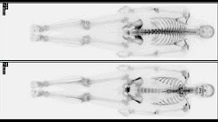 Bone scan and arthritis