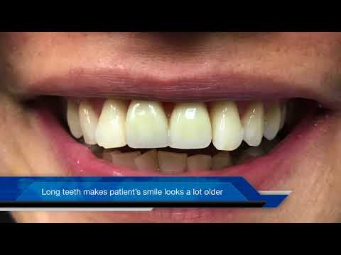 Video: Wat is tandheelkundige odontoplastiek?