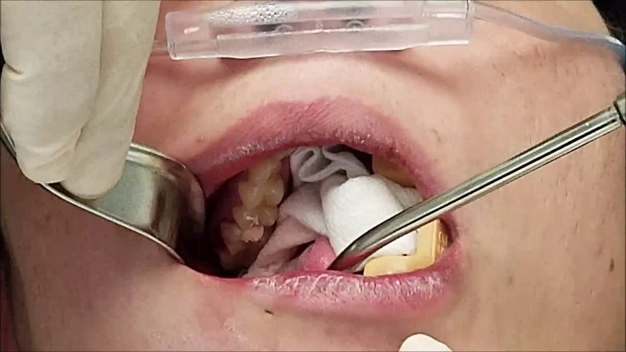 Abscessed Tooth 3 YouTube