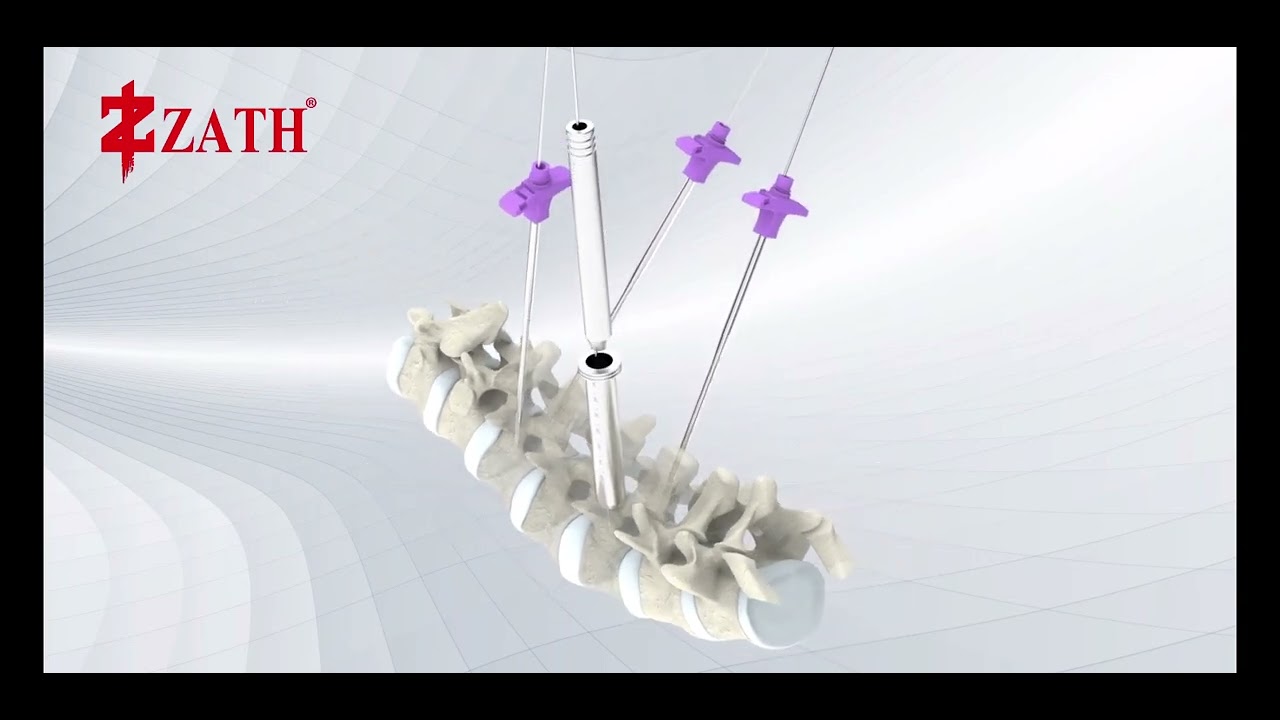 Minimally Invasive Spinal Pedicle Screw