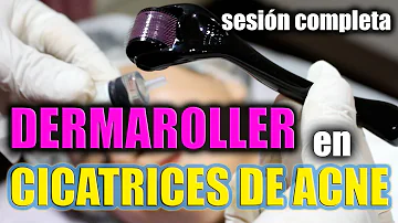 Quantas sessões de DermaRoller para cicatrizes de acne?
