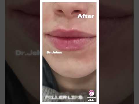 حقن فيلر الشفايف قبل وبعد