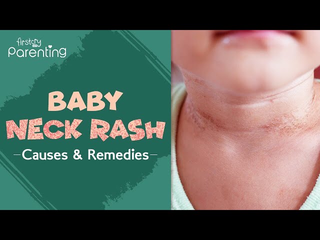 Neck Rash In Babies Reasons Symptoms Treatment Home Remedies