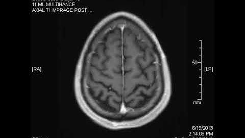 A slideshow of my brain & spinal cord MRIs from 2013.