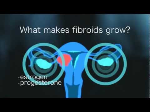 Video: Fibroid Pedunculated: Gejala, Diagnosis Dan Rawatan