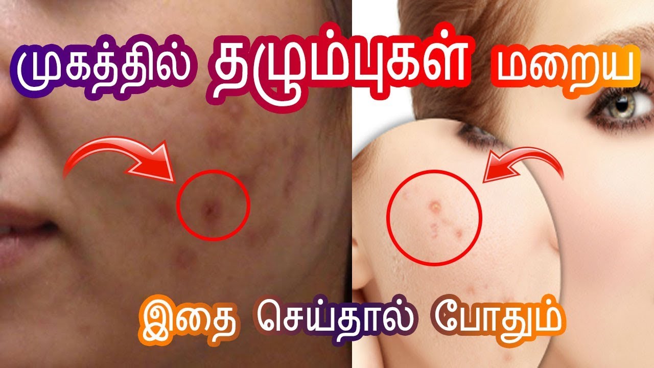 Remove scar in Tamil Cure Pimple Scar Thalumbu Maraiya தழும்பு மறைய Beauty Tips in Tamil