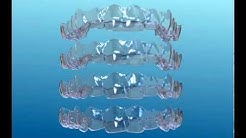 Orthodontic Clear aligners -how aligners work (invisalign)