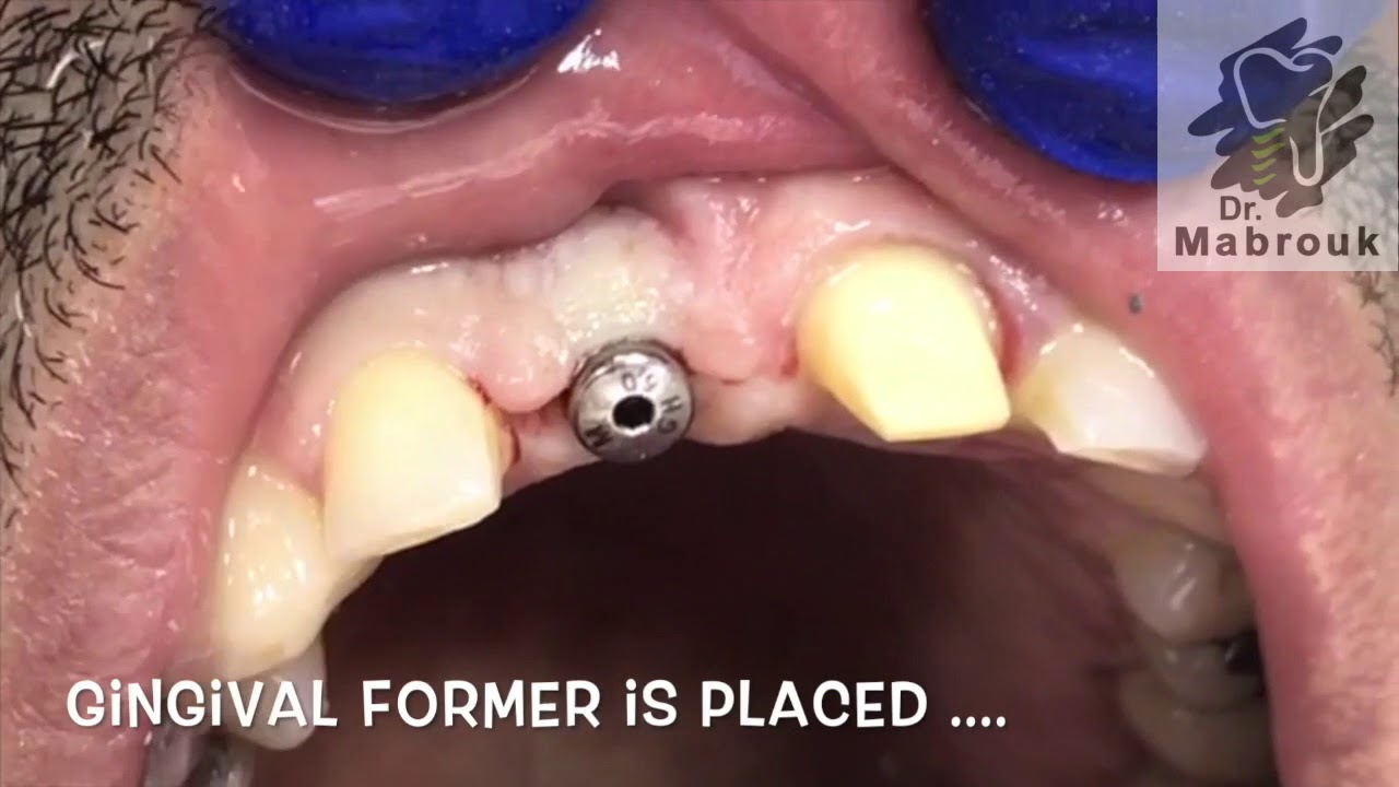 Gingival Former YouTube
