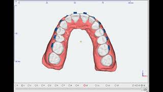 Orthodontic Aligner Treatment Planning using onyx cep software #dentist #orthodontics #orthodontist
