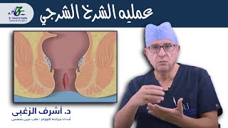 عمليه الشرخ الشرجي الناجحه  - أ.د/ اشرف الزغبي