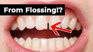 Flossing Causes Gaps?