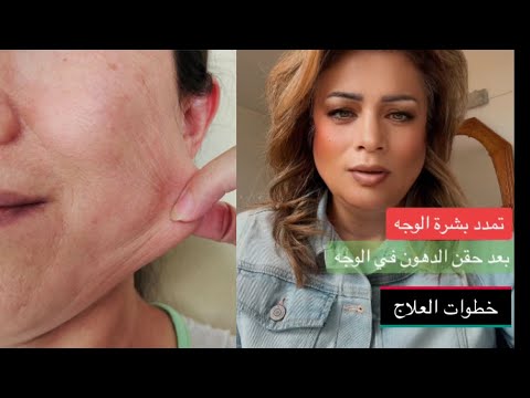 ترهل الوجه بعد حقن الدهون الذاتية مساج الوجه تجربتي الشخصية