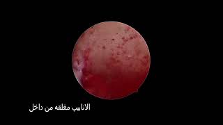 Bilateral proximal tubal block منظار بطن لتسليك الانابيب دكتور عبدالحميد السودة