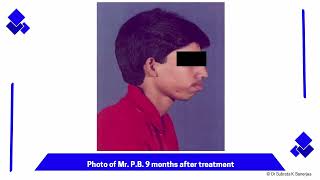 ACH  CASE PPT   D005 FISTULA PB