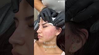 Foxy Eye Thread Lift by Dr Gideon Kwok at Skin Perfect Rancho 🪡 #beauty #threadlift screenshot 4