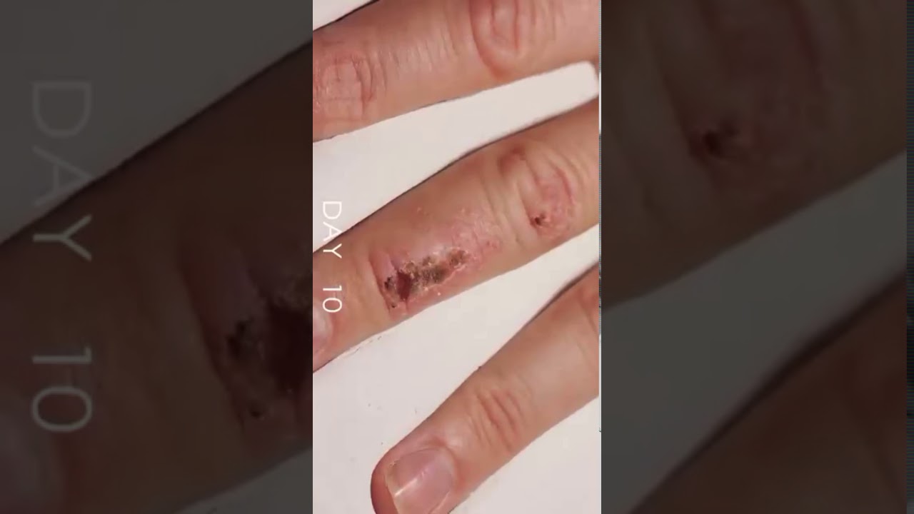 Time laps of wound healing YouTube