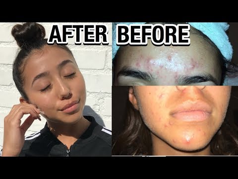 HOW I WENT FROM CYSTIC ACNE TO CLEAR SKIN! Tips to clear your skin! | Ronni Rae