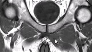 Sports hernia with adductor longus tendon tear