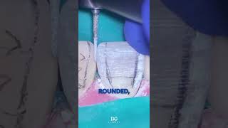 Transitional angle lines are essential in the primary form of direct restorations. #dentistry