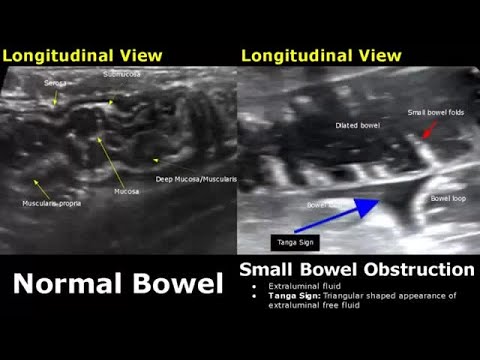 Abdominal Ultrasound Normal Vs Abnormal Images | Liver, Gallbladder, Pancreas, Kidney, Hernia USG