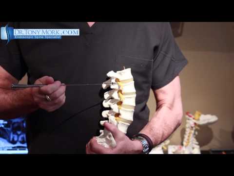 Orthopaedic surgeon Brian J. Neuman, M.D., discusses causes and symptoms for cervical spinalOrthopae. 