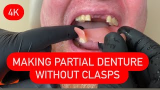 MAKING PARTIAL DENTURE WITHOUT CLASPS ALL STEPS AND INSERTION 4K #waxbae