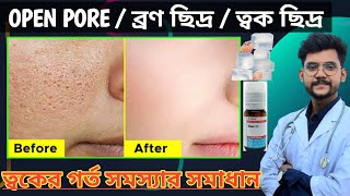 মুখের ব্রণ ও ত্বকের গর্ত দূর করার উপায়। How to remove large Open pores on face & skin treatment