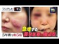 【Mr.サンデー】脂肪吸引直後に意識不明で救急搬送！急増する美容医療“後遺症”の実態【実録ドキュメント】