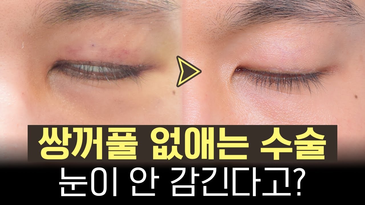 눈 안 감김, 토안이 걱정되시나요?  [쌍없수술, 눈안감김걱정, 토안걱정]