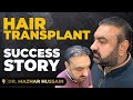 Shahzad Abdullah | Natural & Real Results | Success Stories | FUE | Dr. Mazhar Hussain 💇♂️✨
