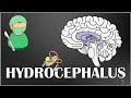 Hydrocephalus - Causes, Types, Signs and Symptoms, Pathophysiology, Diagnosis and Treatment