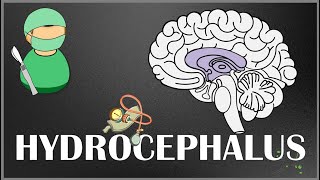Hydrocephalus  Causes, Types, Signs and Symptoms, Pathophysiology, Diagnosis and Treatment