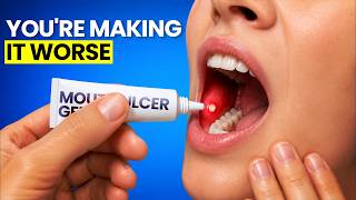 Your Mouth Ulcers Aren t Random Here s the Pattern