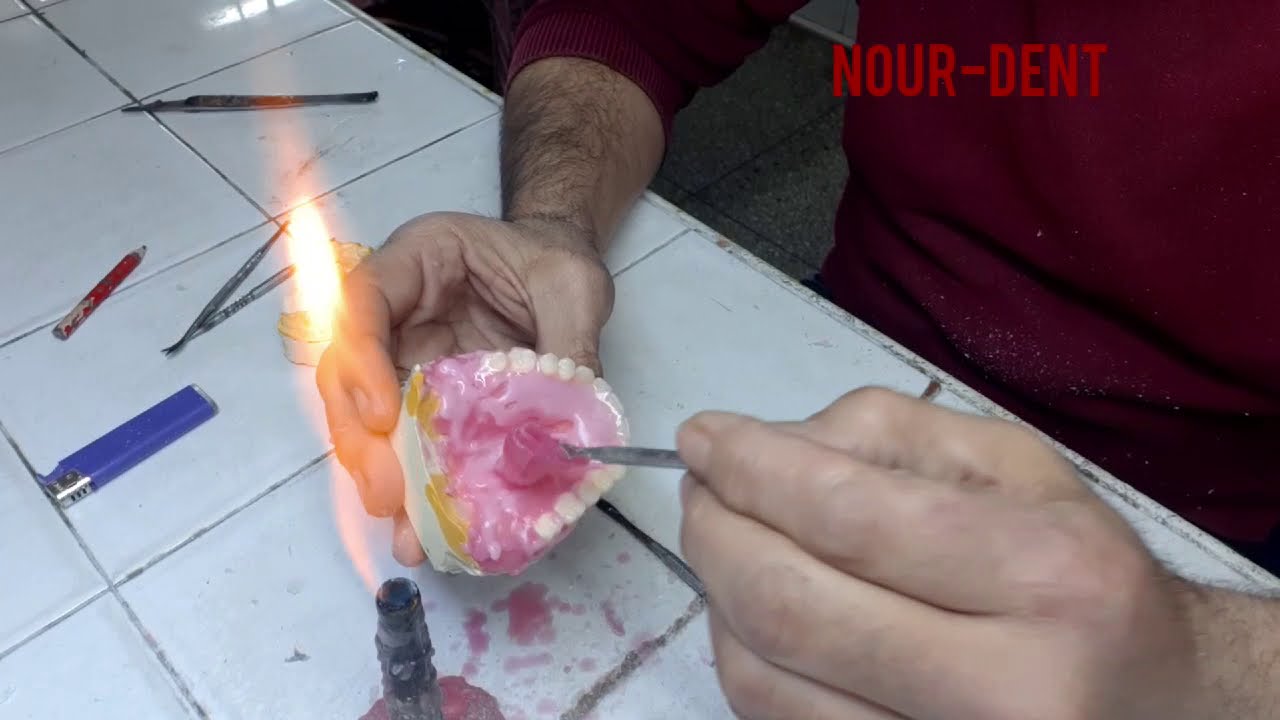 Finition de cire prothese totale du haut #Prothèse_dentaire