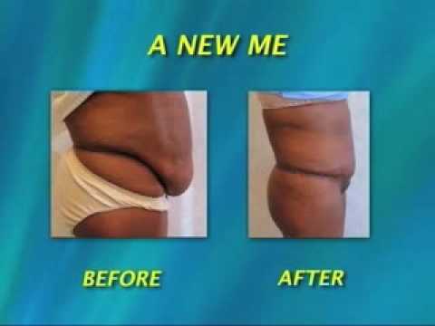 www.plastic-surgeon.us Maryland plastic surgeon, Dr. Mark E. Richards, shows us some patient tummy tuck surgery before and after photos and explains the surgical techniques that he utilized to achieve these results. If you feel as though you may be a good candidate for tummy tuck surgery please contact us to schedule your personal consultation to explore your options. Mark E. Richards, MD 11300 Rockville Pike Suite 912 N. Bethesda, Maryland 20852 (301) 468-3669