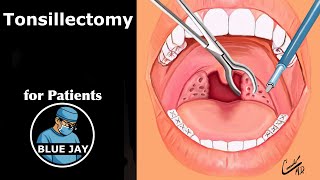 Tonsillectomy: Patient Education