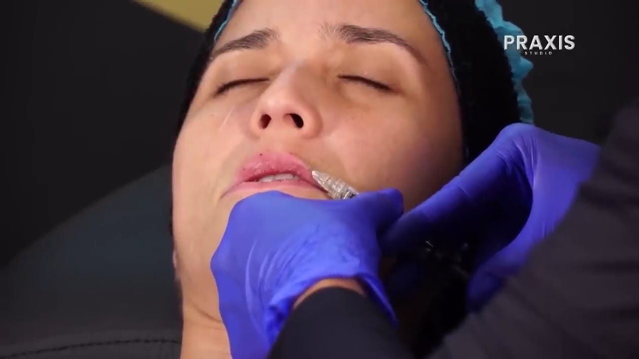 TÉCNICA DE INYECCIÓN LABIAL MULTITÉCNICA CON ÁCIDO HIALURÓNICO - DRA. MARCELA ÁVILA