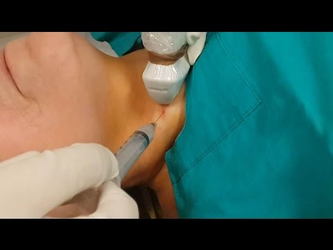 FINE NEEDLE ASPIRATION BIOPSY