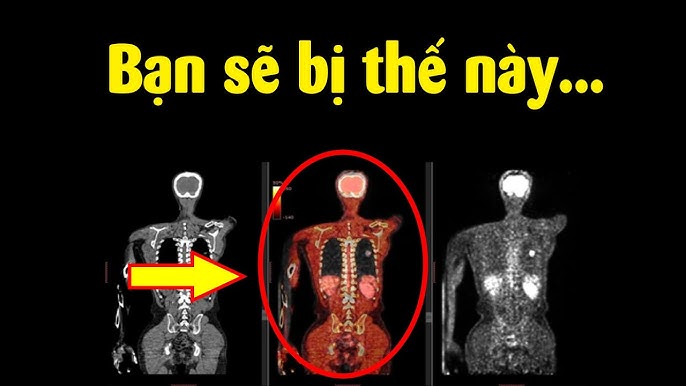 Bị nhiễm phóng xạ sẽ như thế nào? Hiểu rõ để bảo vệ sức khỏe và môi trường